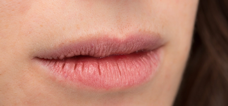 chapped lips symptoms